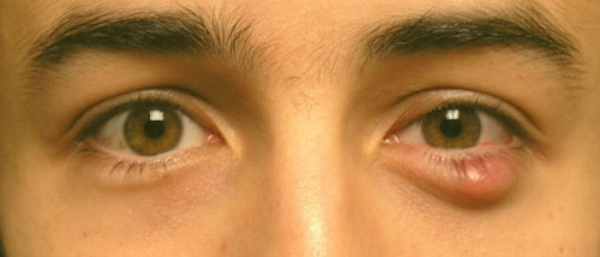 Жировик на глазу