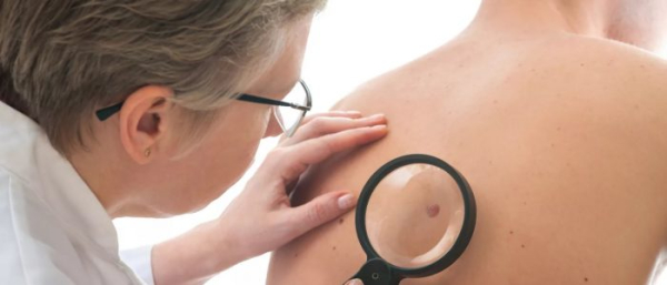 Атерома спины