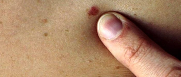 Как убрать родинку в домашних условиях?