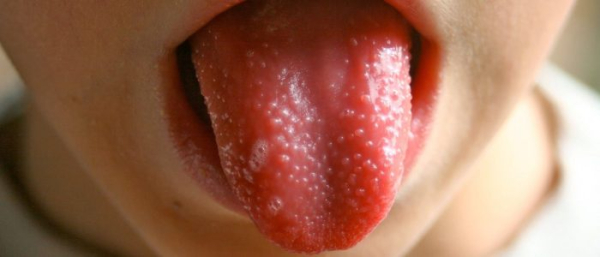 Наросты на языке