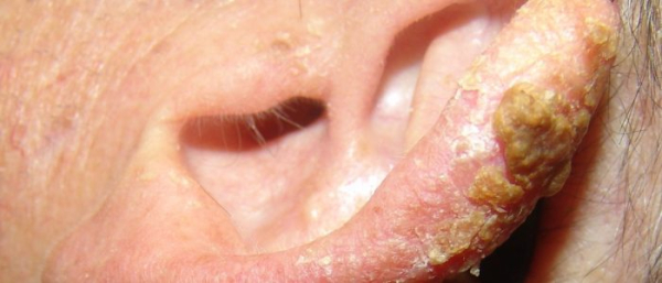 Что такое кератоз?