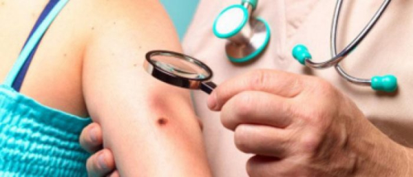 Признаки меланомы