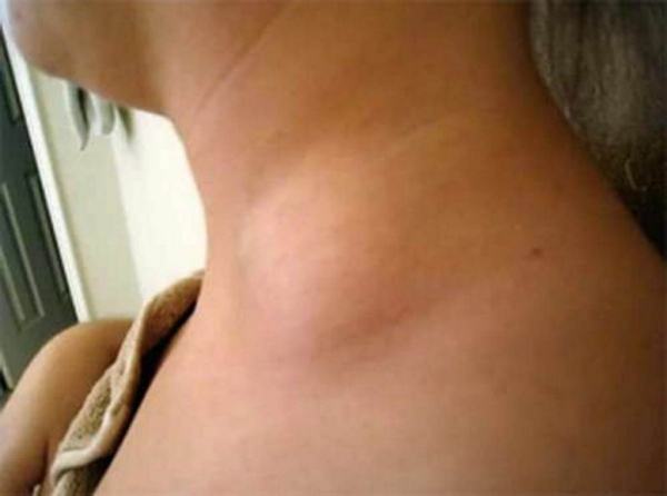 Липома на шее