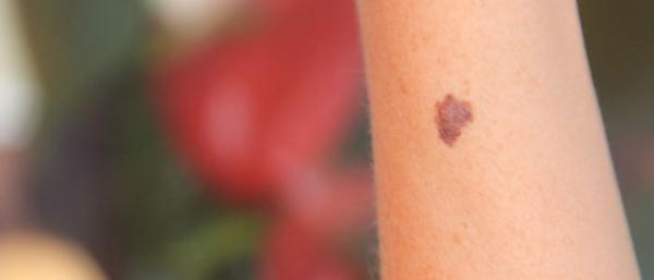 Диспластические невусы