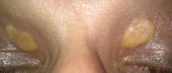 Ксантоматоз кожи