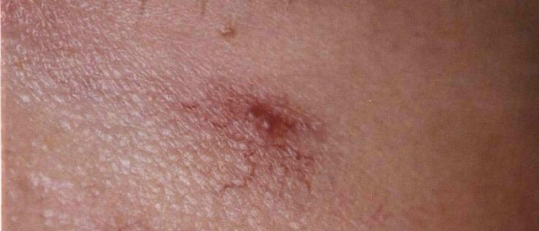 Звездчатая гемангиома