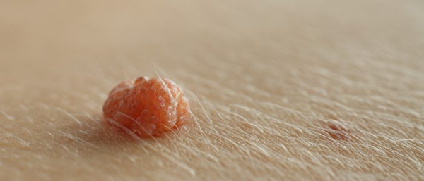 Растет родинка