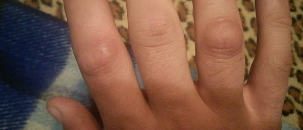 Нарост на руке