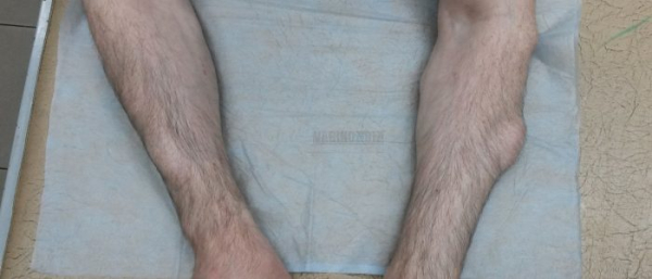 Может ли гигрома пройти сама?