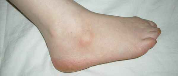 Гигрома у ребенка