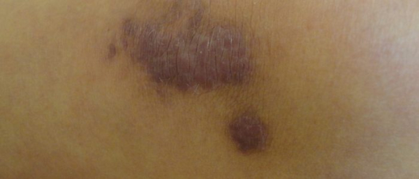 Меланома на теле