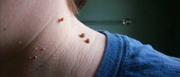 Висячая родинка