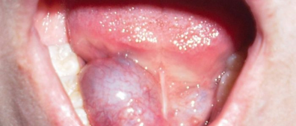 Гемангиомы в ротовой полости
