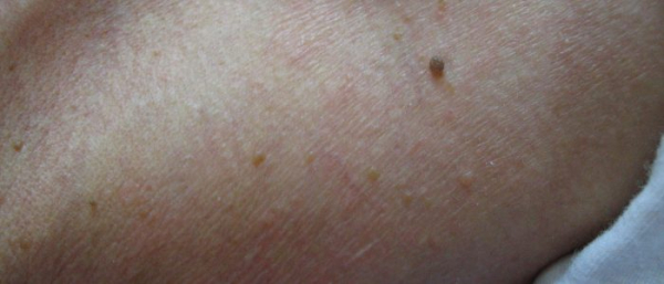 Себорейная бородавка