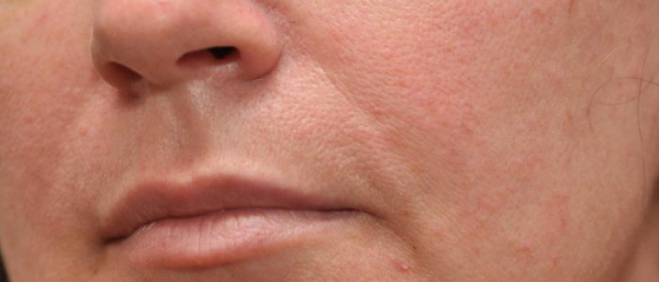 Милиумы кожи