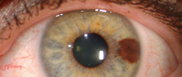 Меланома глаз