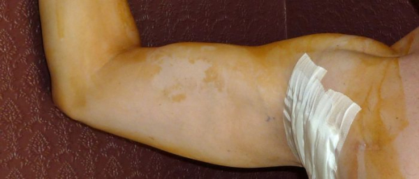 Липосаркома или липома