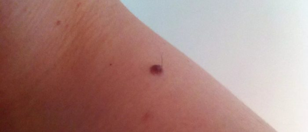 Розовая родинка