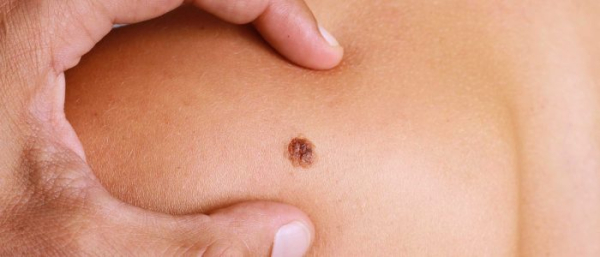 Что будет если сковырнуть родинку?