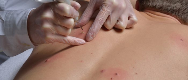 Лазерное удаление атеромы