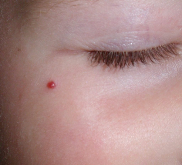 Гемангиома по наследству