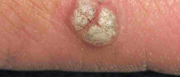 Бородавка или Папиллома