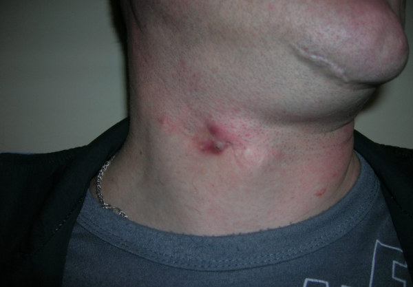 Атерома после операции по удалению