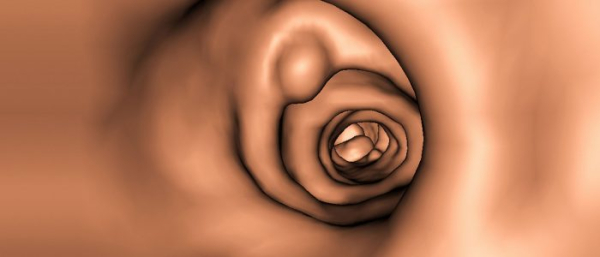 Папилломы в кишечнике