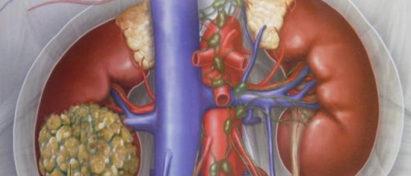 Наросты на почке