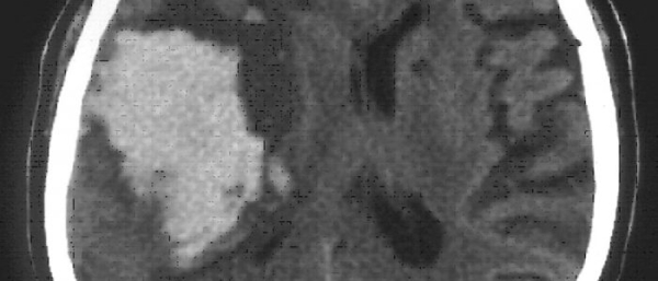 Гемангиома сосудов мозга