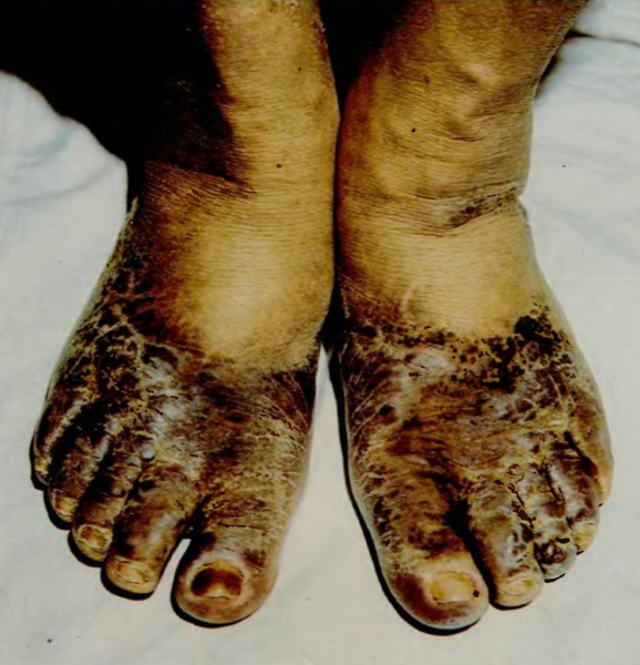 Саркомы капоши