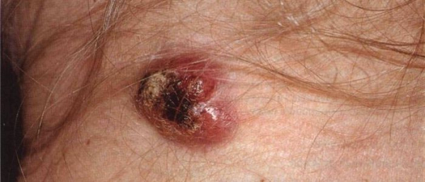 Метастазы меланомы