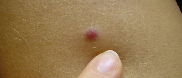 Что будет если выдавить родинку