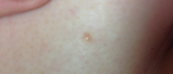 Ахроматическая меланома