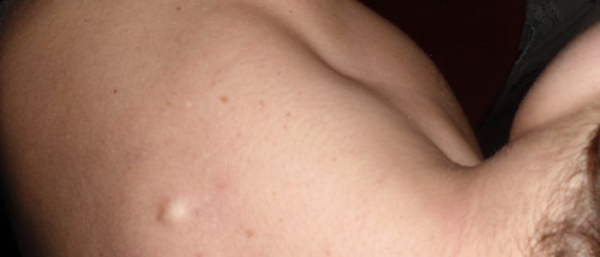 Липома у человека