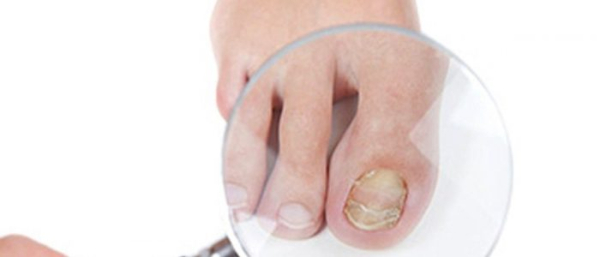 Меланома ногтей