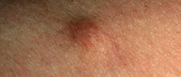 Фиброматоз кожи