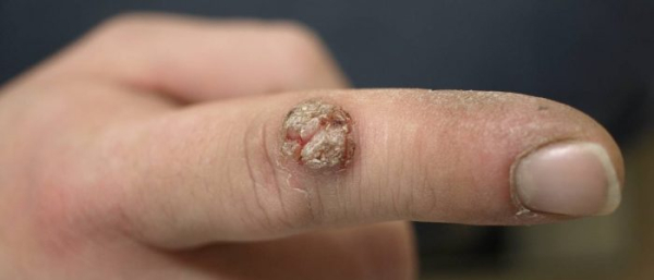 Лечение папилломы лекарства