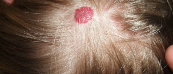 Гемангиома головы