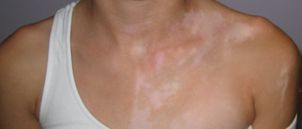 Белые родимые пятна