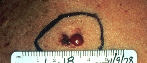 BRAF мутация при меланоме