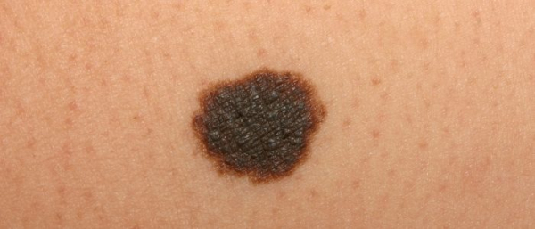 Меланоцитарные невусы