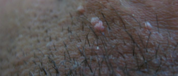 Плоскоклеточные папилломы