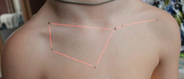 Родинка на грудной клетке