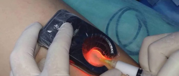 Склерозирование гемангиом