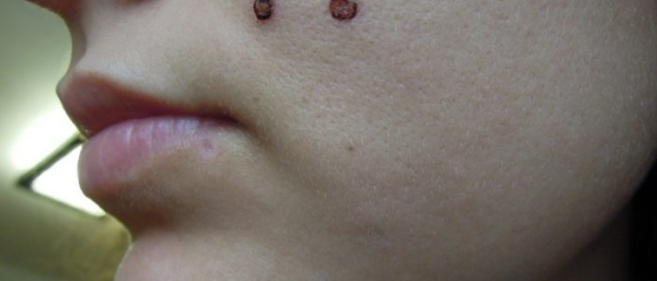 Какие родинки опасны?