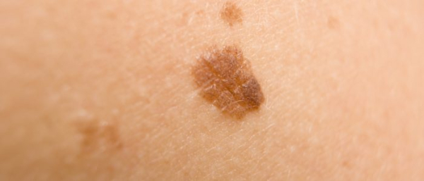 Плоские родинки