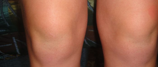 Родинки на ноге