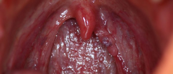 Красная папиллома