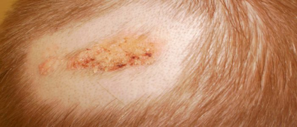 Меланома у ребенка